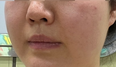 Thermage 热玛吉恢复记录｜皮肤松弛、轮廓模糊终于有救了 2