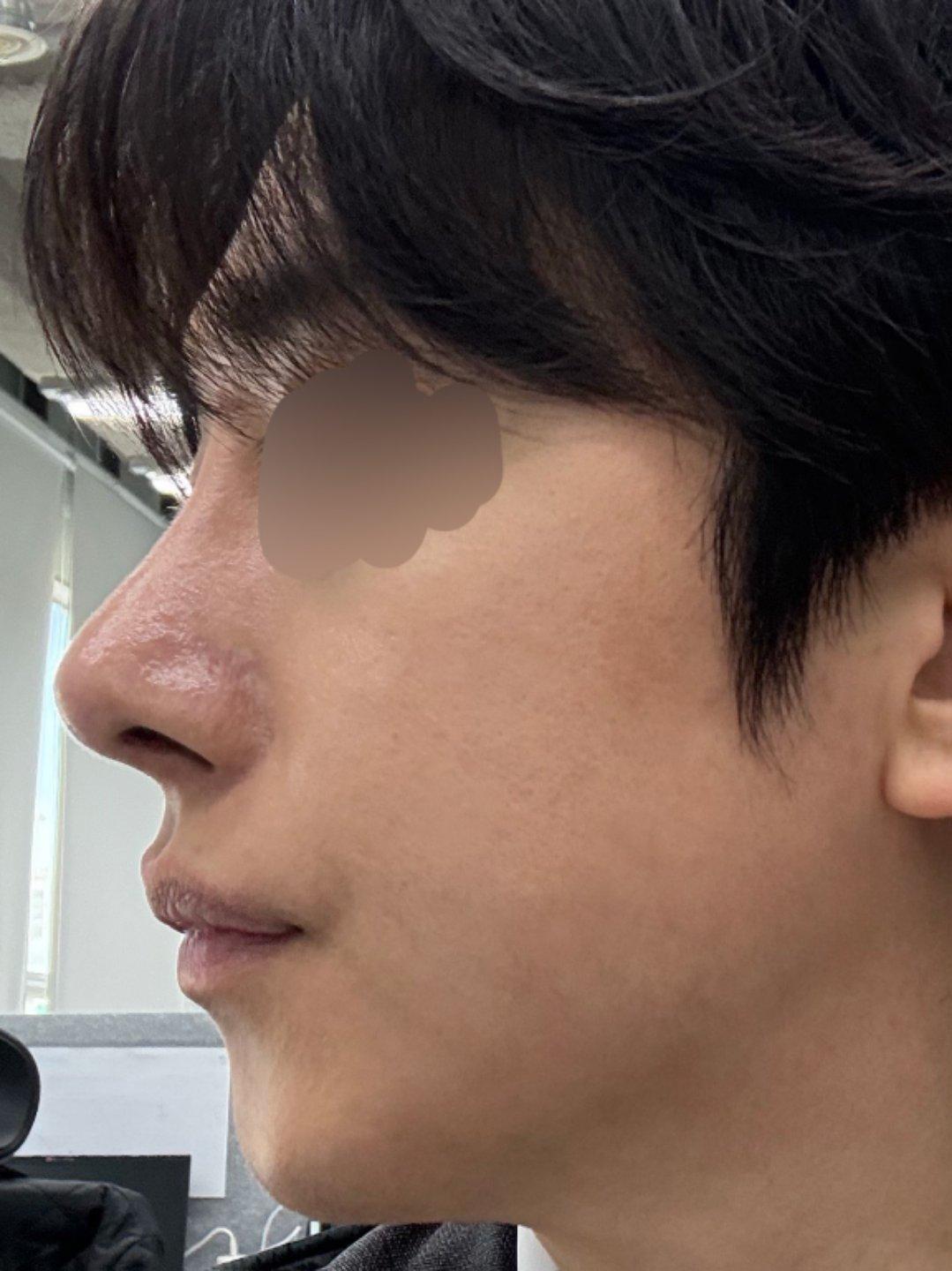My profile is straight and the tip is refined but natural — so glad I did Rhinoplasty 6