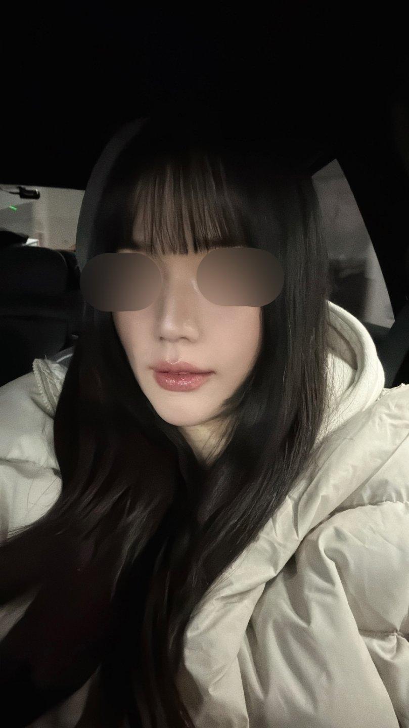 A few weeks after Rhinoplasty 🙌 3