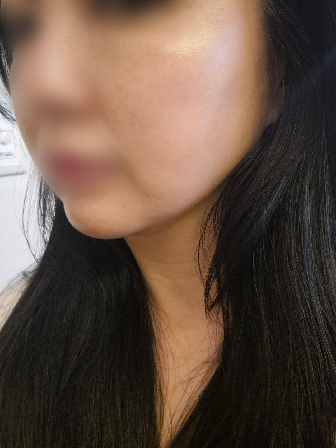 终于对眉眼和下颌下垂动手了——Ultherapy 超声提升 5