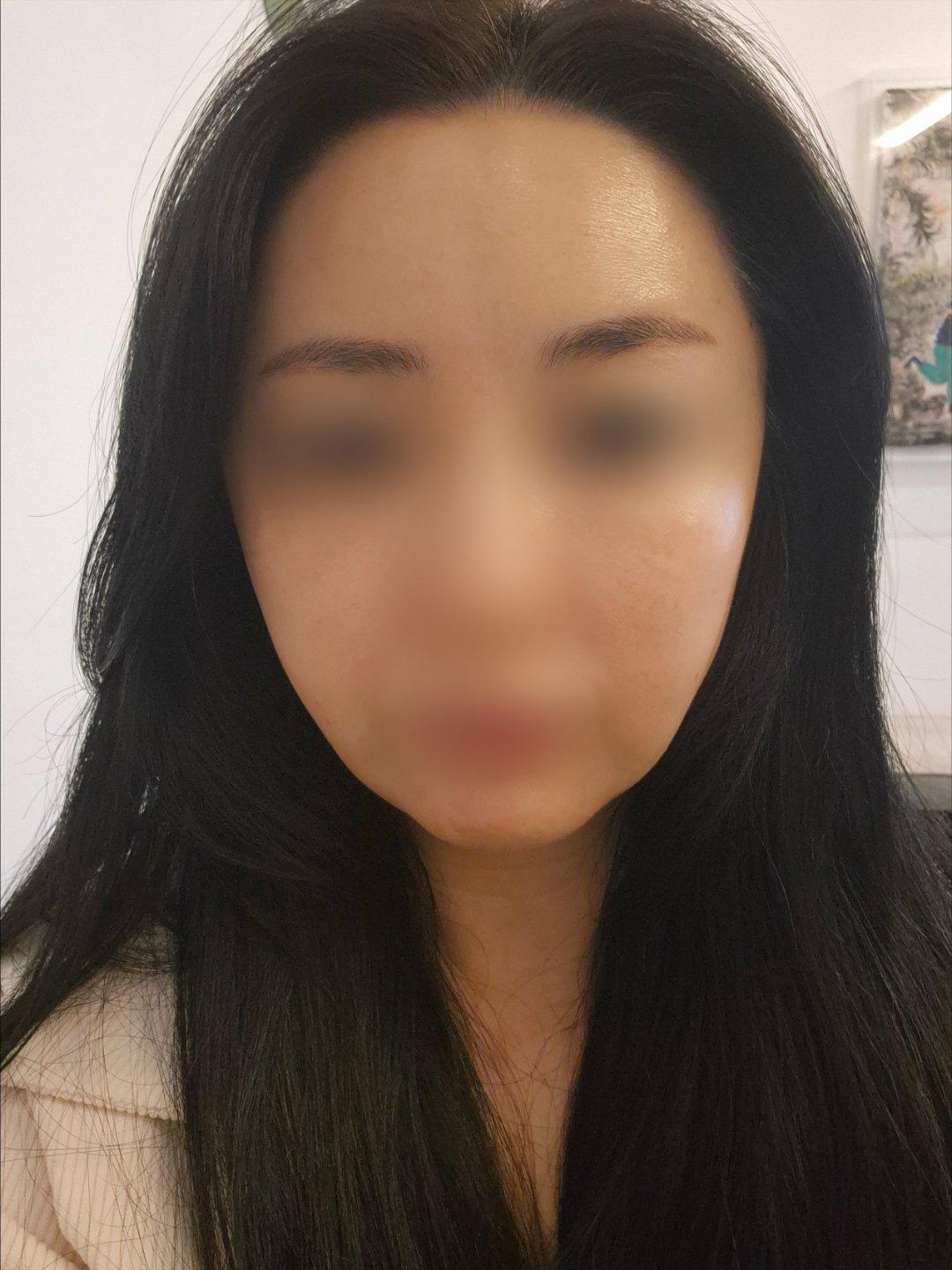 终于对眉眼和下颌下垂动手了——Ultherapy 超声提升 2