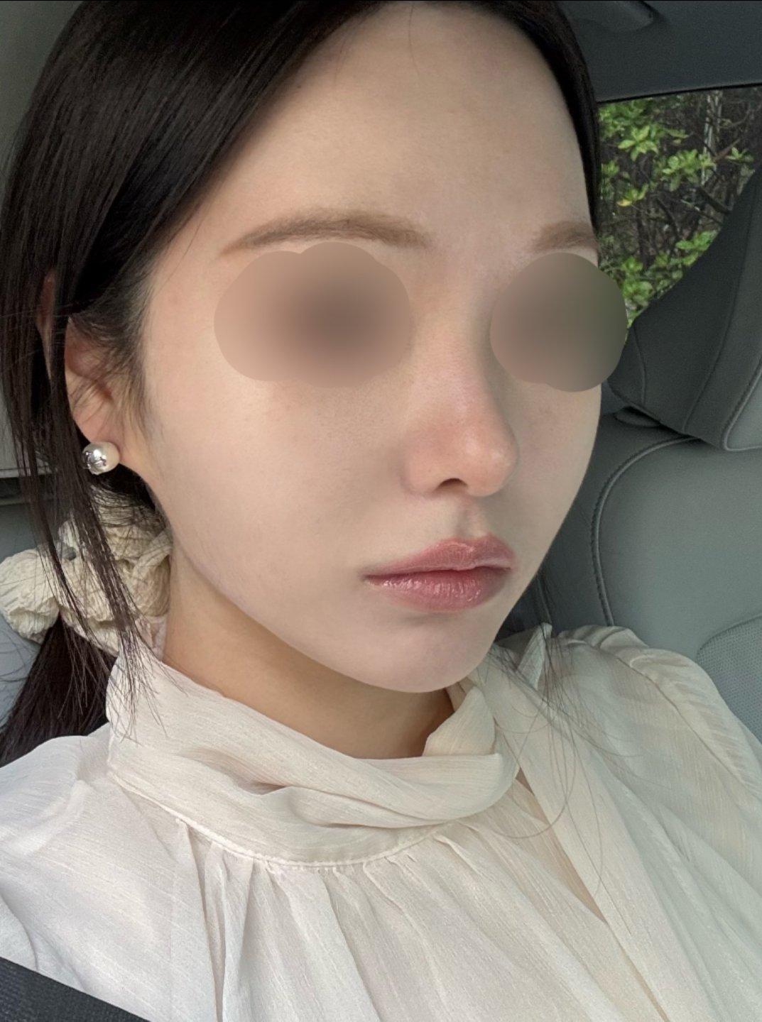 My profile is straight and the tip is refined but natural — so glad I did Rhinoplasty 5