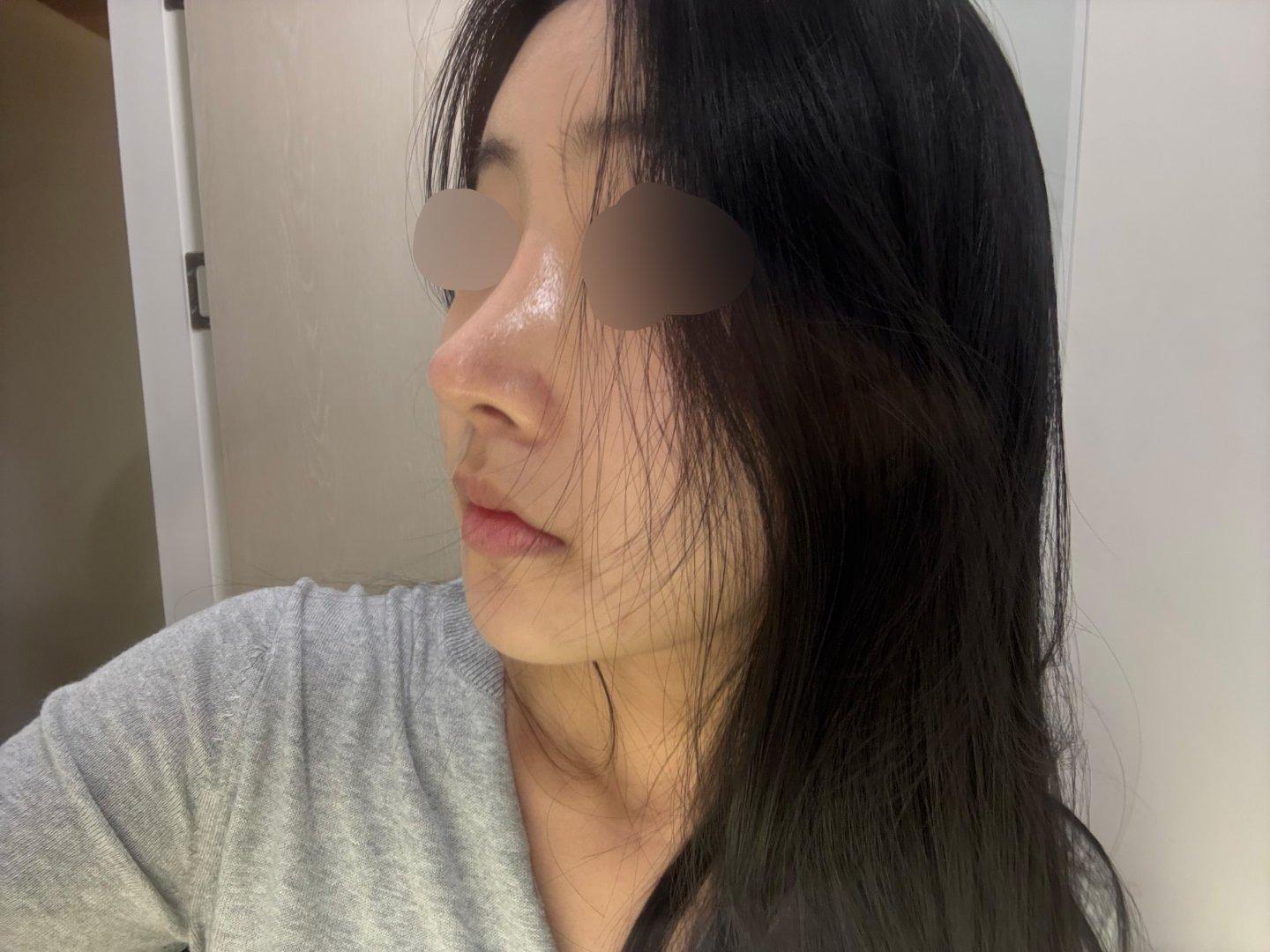 Finally tackled a low bridge and a bulbous tip with Rhinoplasty 6