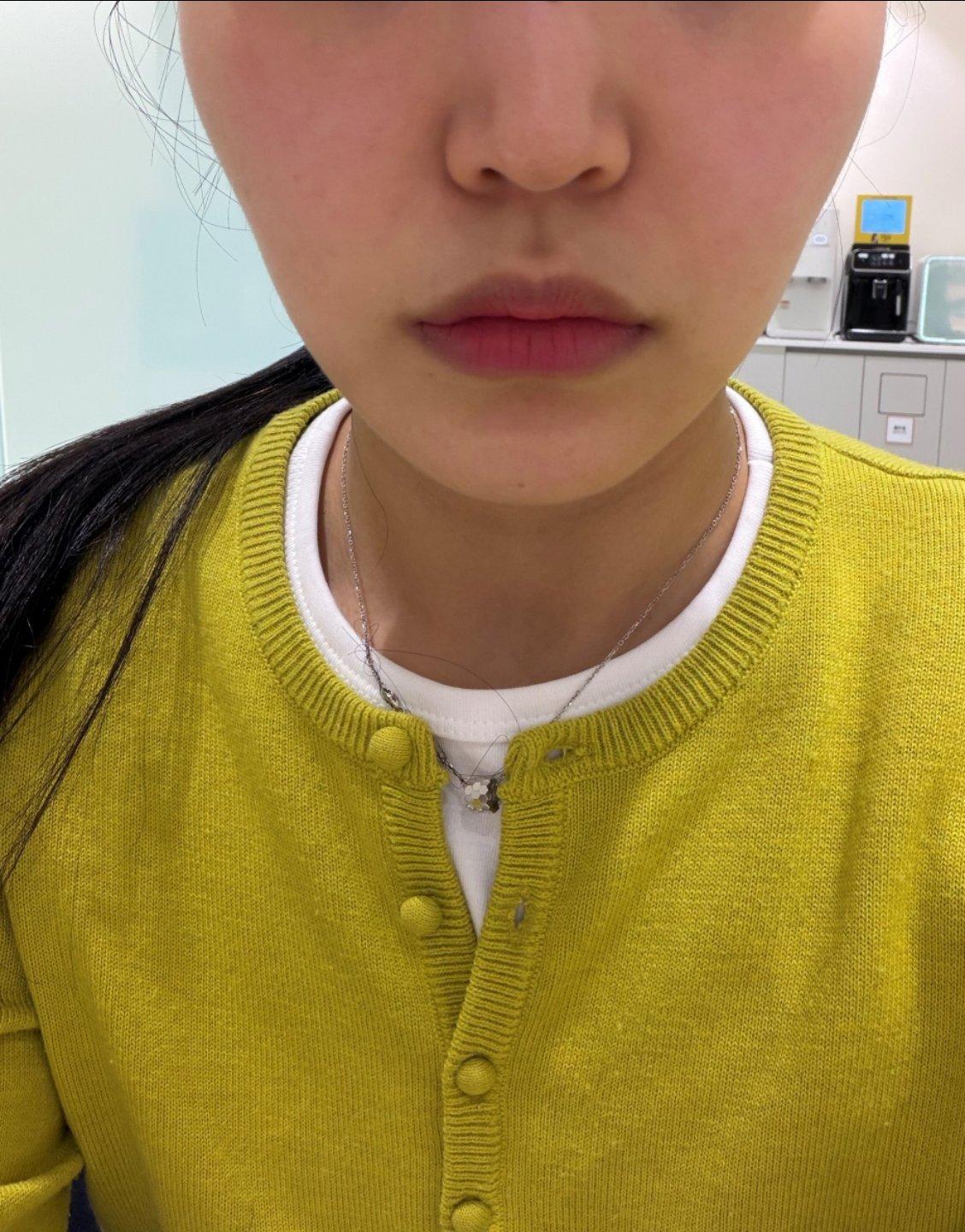 FaceTite 黄金微雕术后几周，下颌线紧致，恢复还很快🙌 2