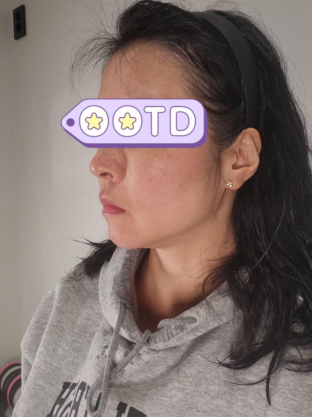 终于对抬头纹和川字纹动手了——Dysport 丽舒妥 2