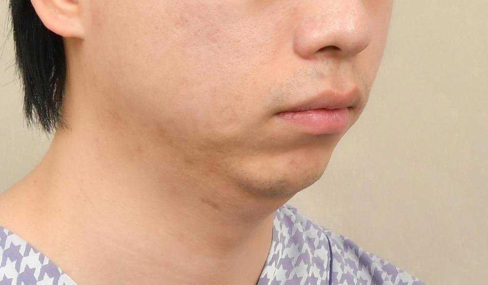 Chin Implant 3