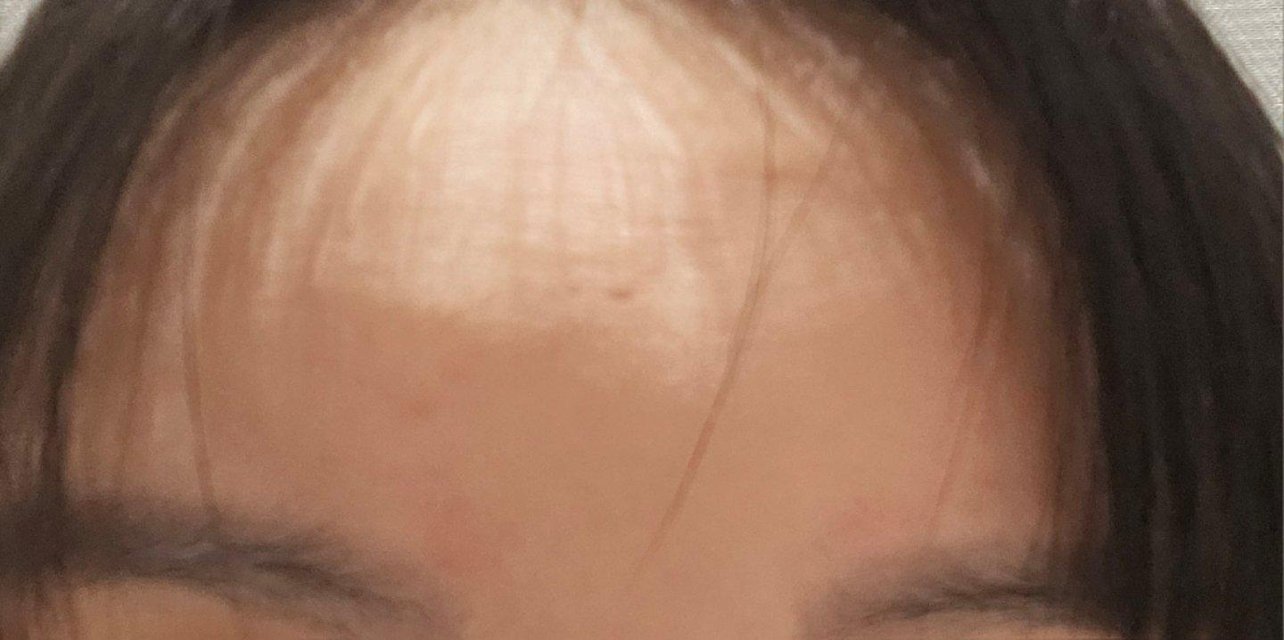 Botox 肉毒素恢复记录｜抬头纹和眉间纹终于有救了