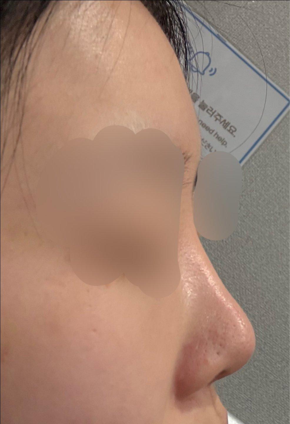 Finally tackled a low bridge and a bulbous tip with Rhinoplasty 3
