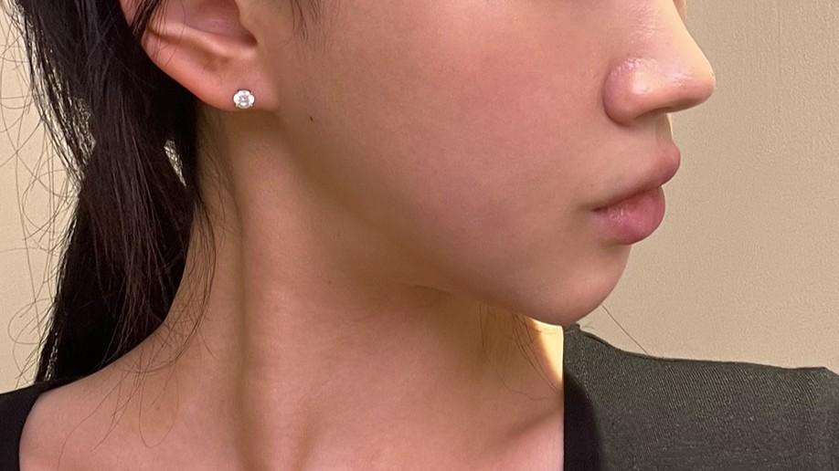 My face filled back out so naturally — so glad I did Sculptra 2
