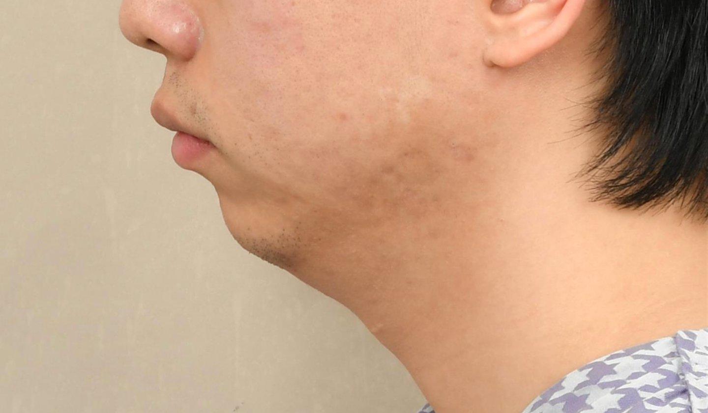 Chin Implant 5