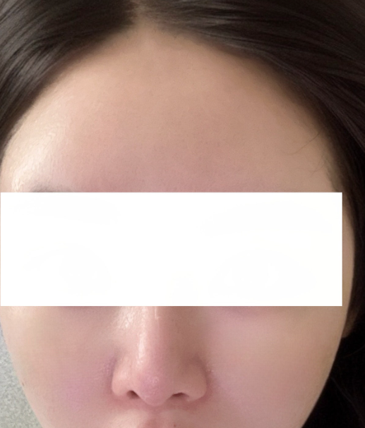 Thermage 热玛吉术后几周，脸明显提拉，还没有恢复期🙌 2