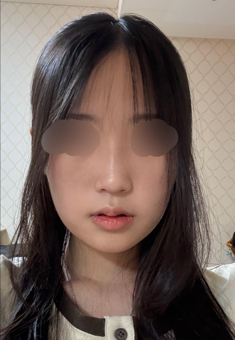 My profile is straight and the tip is refined but natural — so glad I did Rhinoplasty 4