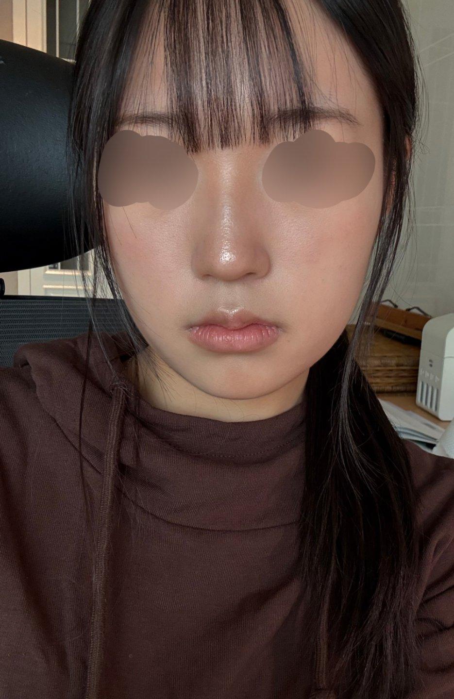 My profile is straight and the tip is refined but natural — so glad I did Rhinoplasty 3