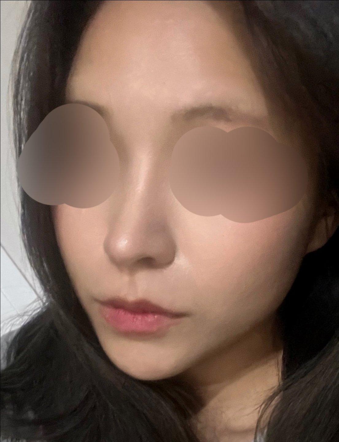 鼻综合整形恢复记录｜鼻梁低、鼻头圆钝终于有救了 7