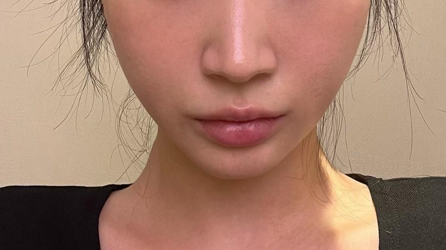 My face filled back out so naturally — so glad I did Sculptra 1