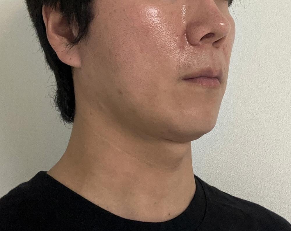 Sculptra 童颜针术后几周，面部慢慢饱满，自然又持久🙌 3