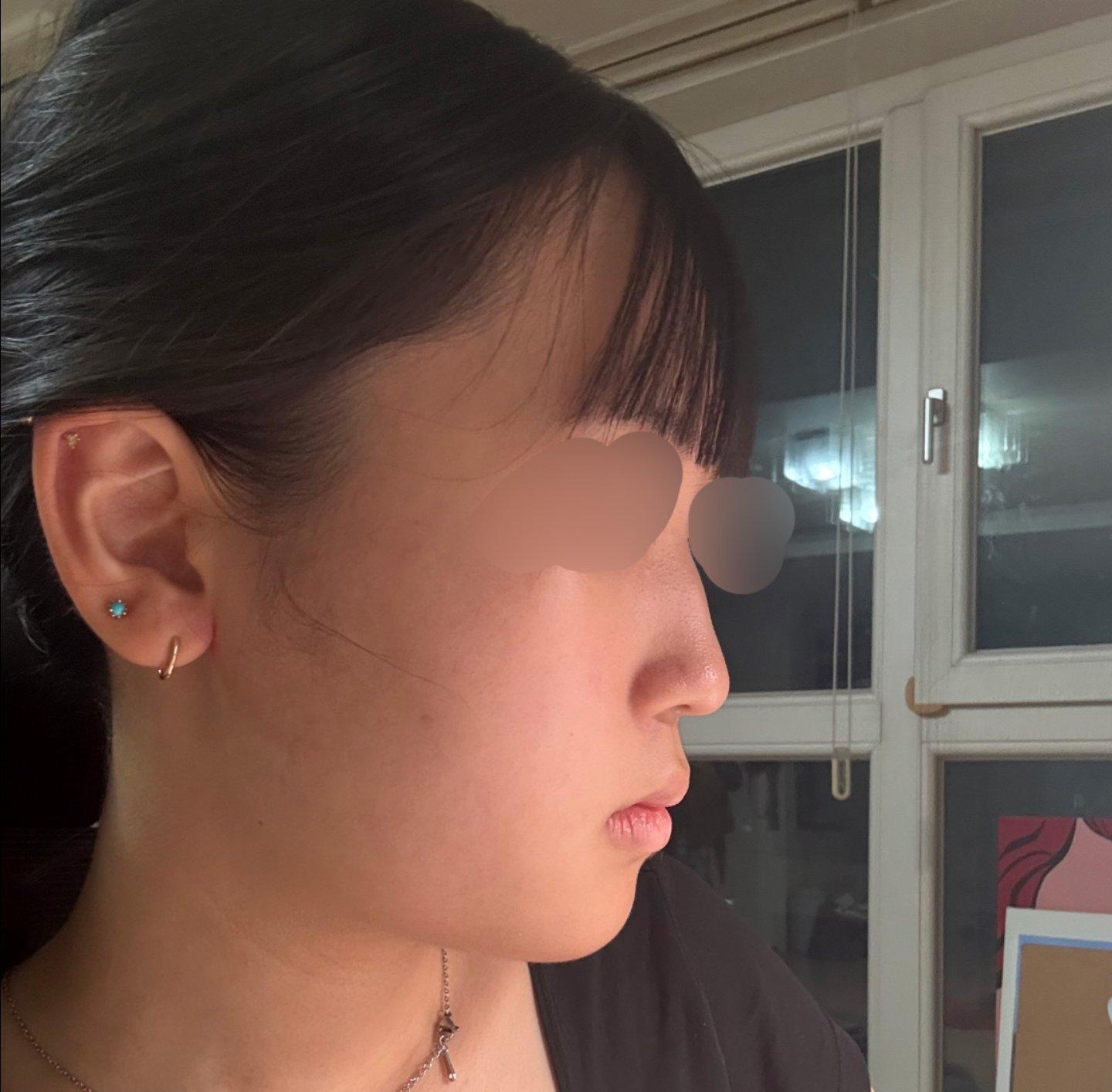 My profile is straight and the tip is refined but natural — so glad I did Rhinoplasty 2