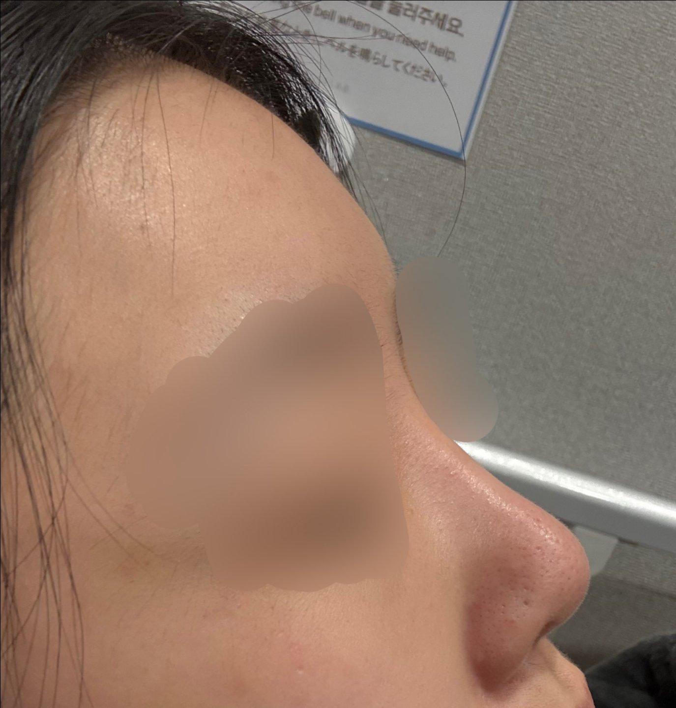 Finally tackled a low bridge and a bulbous tip with Rhinoplasty 2