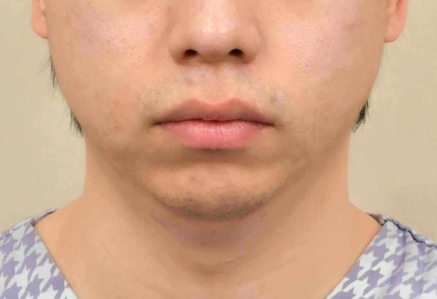 Chin Implant 4