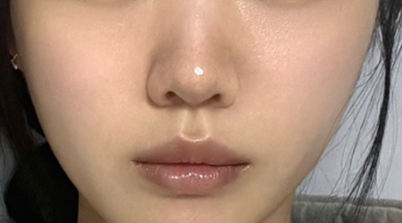 在 FlowMD 做了Thermage 热玛吉，真实分享✨ 2
