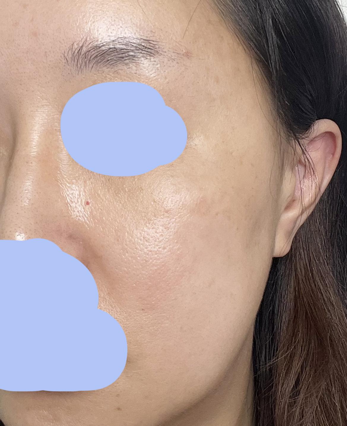 Sciton BBL 宽光谱恢复记录｜雀斑和光老化终于有救了 2