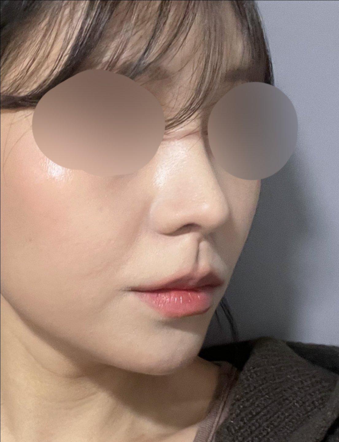 鼻综合整形恢复记录｜鼻梁低、鼻头圆钝终于有救了 5