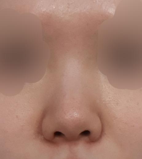 My profile is straight and the tip is refined but natural — so glad I did Rhinoplasty 2
