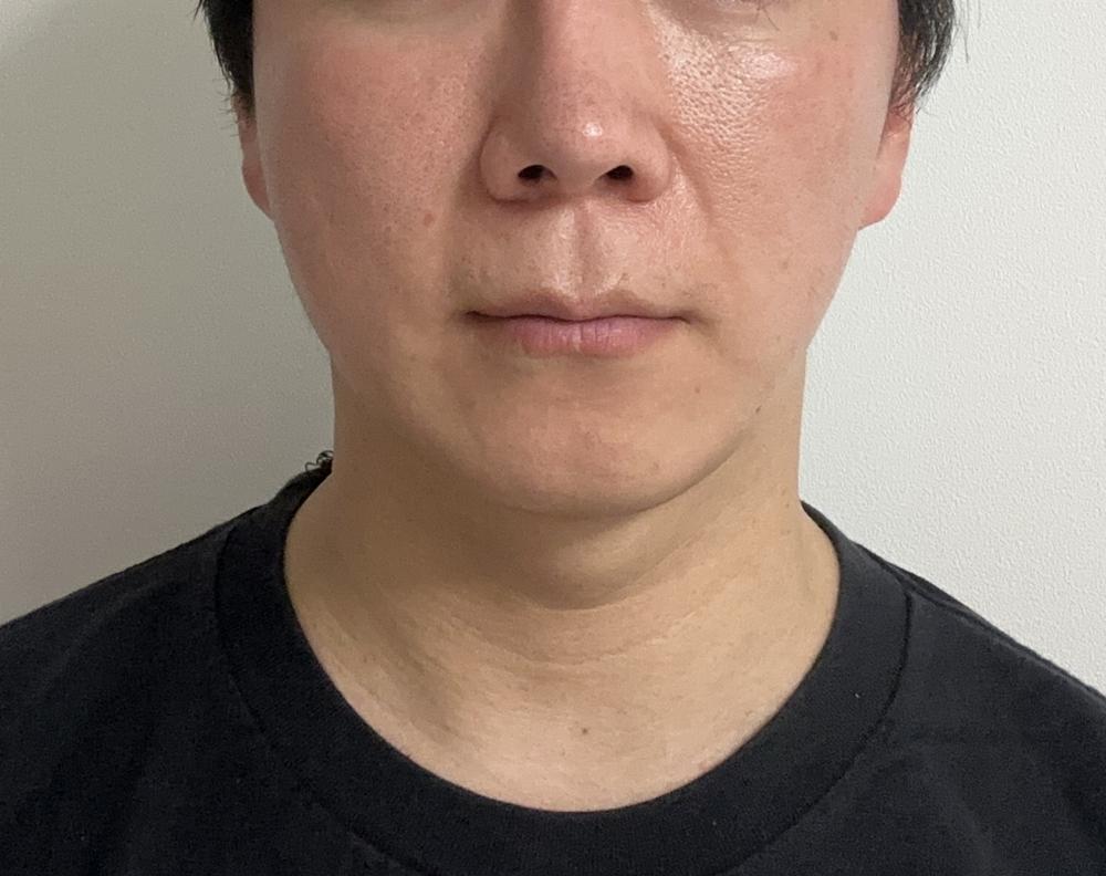Sculptra 童颜针术后几周，面部慢慢饱满，自然又持久🙌