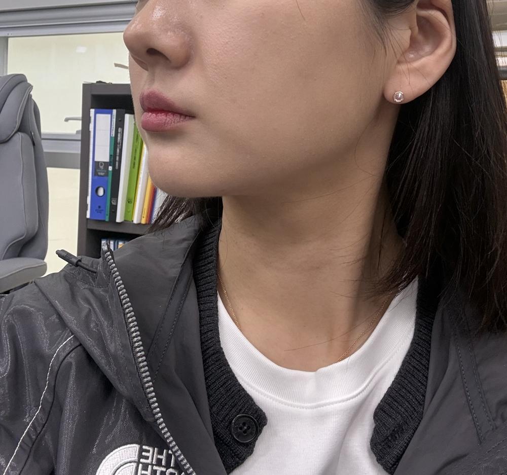 终于对面部凹陷、显憔悴动手了——Sculptra 童颜针 2