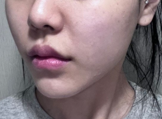 Thermage 热玛吉术后几周，脸明显提拉，还没有恢复期🙌