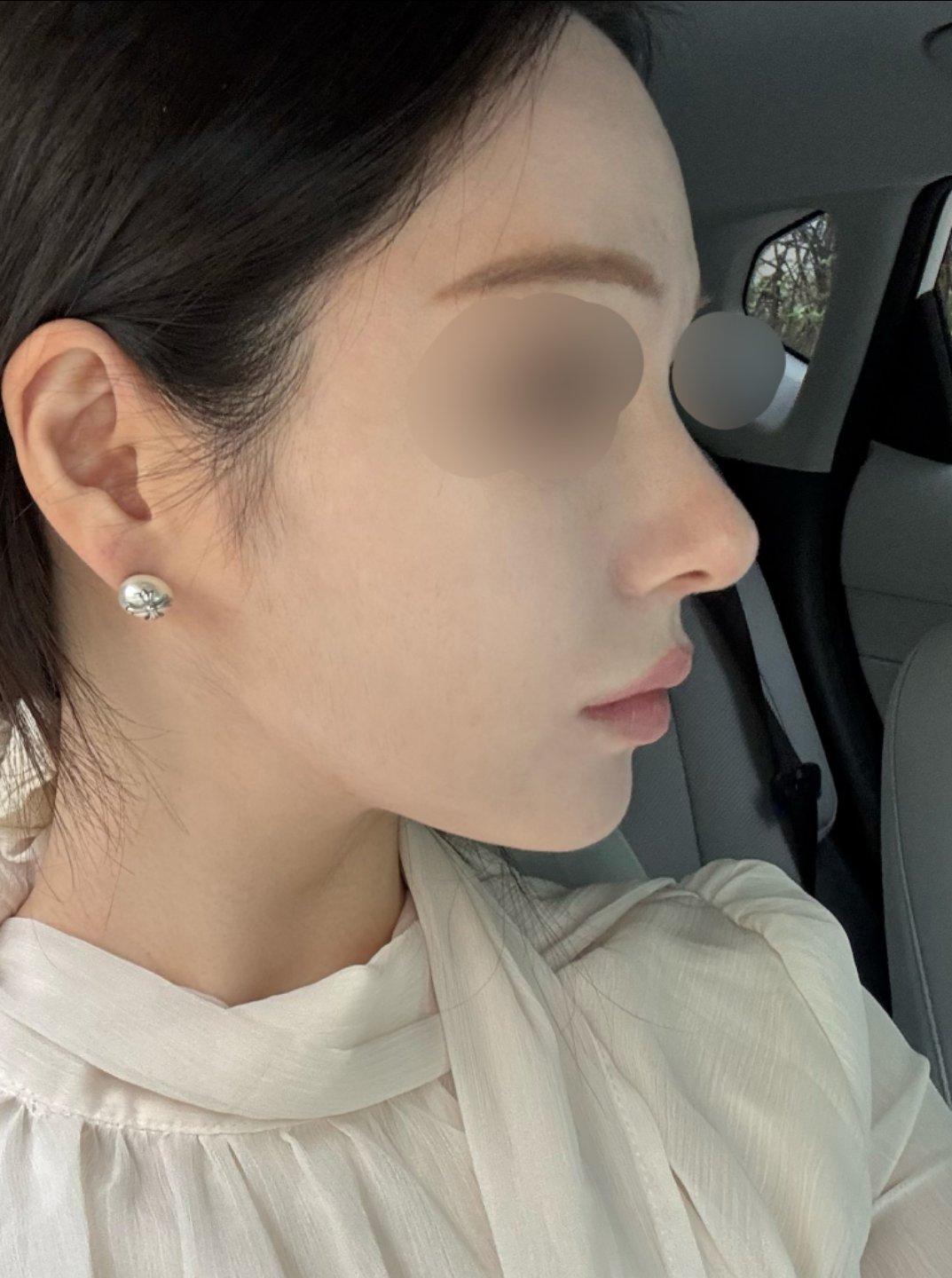 My profile is straight and the tip is refined but natural — so glad I did Rhinoplasty 3