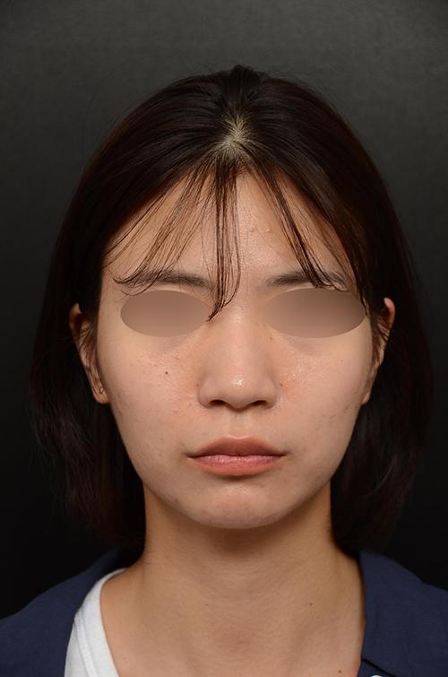 My Rhinoplasty experience at FlowMD ✨ 2