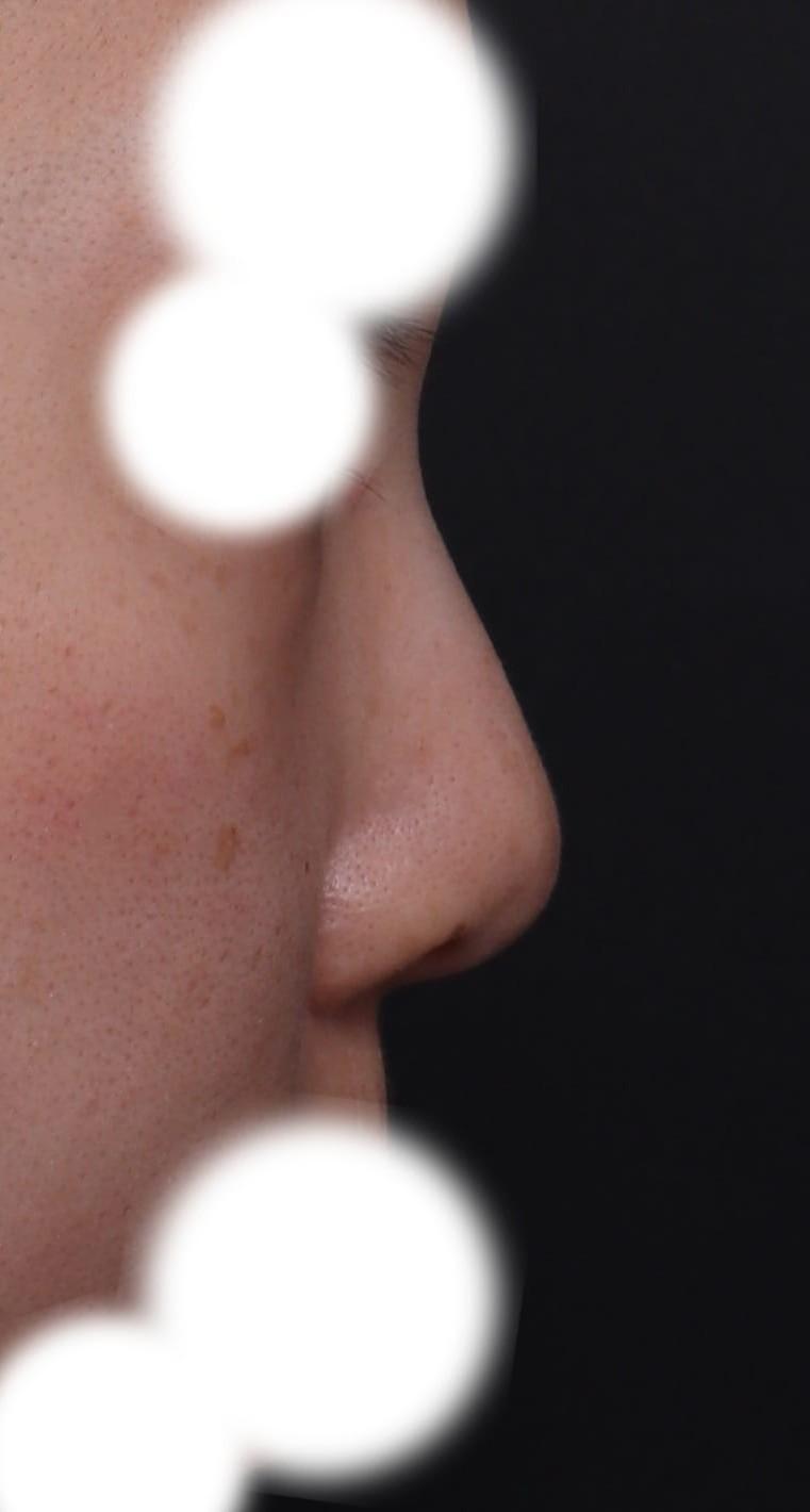 Laser Hair Removal 2