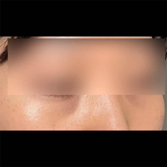 My under-eyes look fresh, no more tired look — so glad I did Lower Blepharoplasty 3
