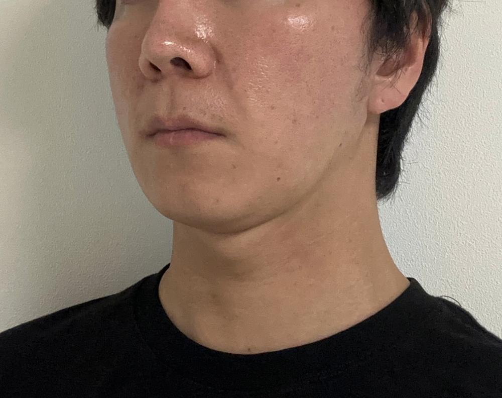 Sculptra 童颜针术后几周，面部慢慢饱满，自然又持久🙌 2