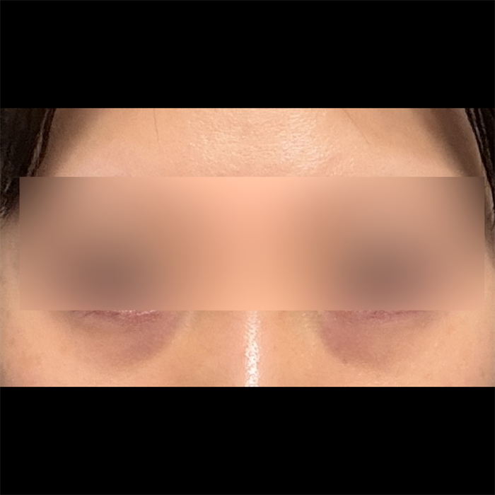 My under-eyes look fresh, no more tired look — so glad I did Lower Blepharoplasty 2