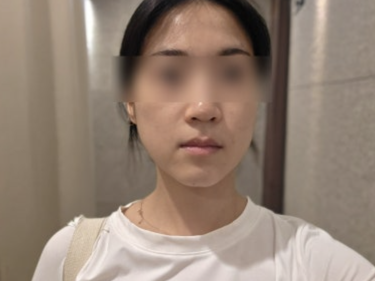 My smile lines softened and my jaw looks tighter — so glad I did Fotona 4D 1