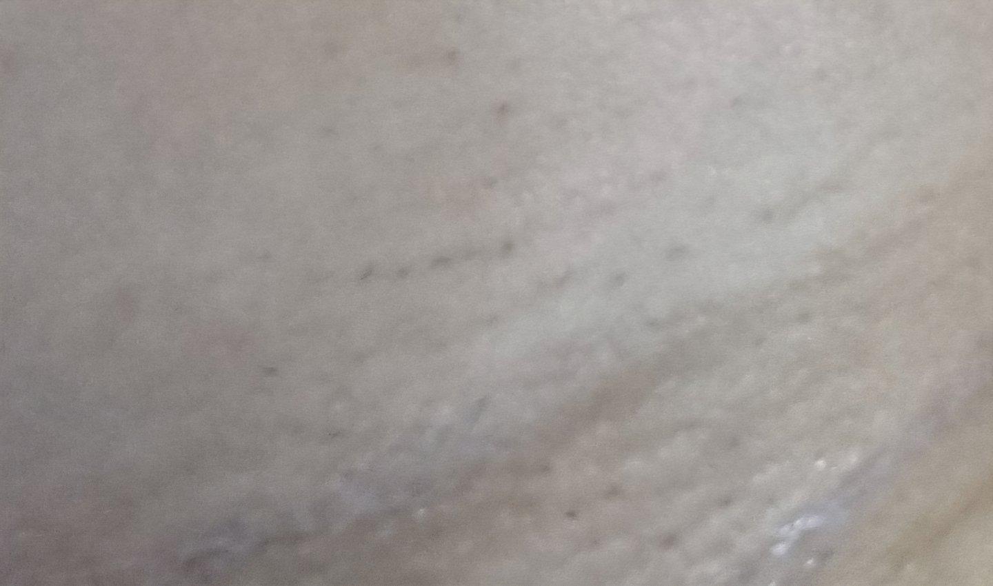 Finally tackled constant shaving and ingrowns with Laser Hair Removal