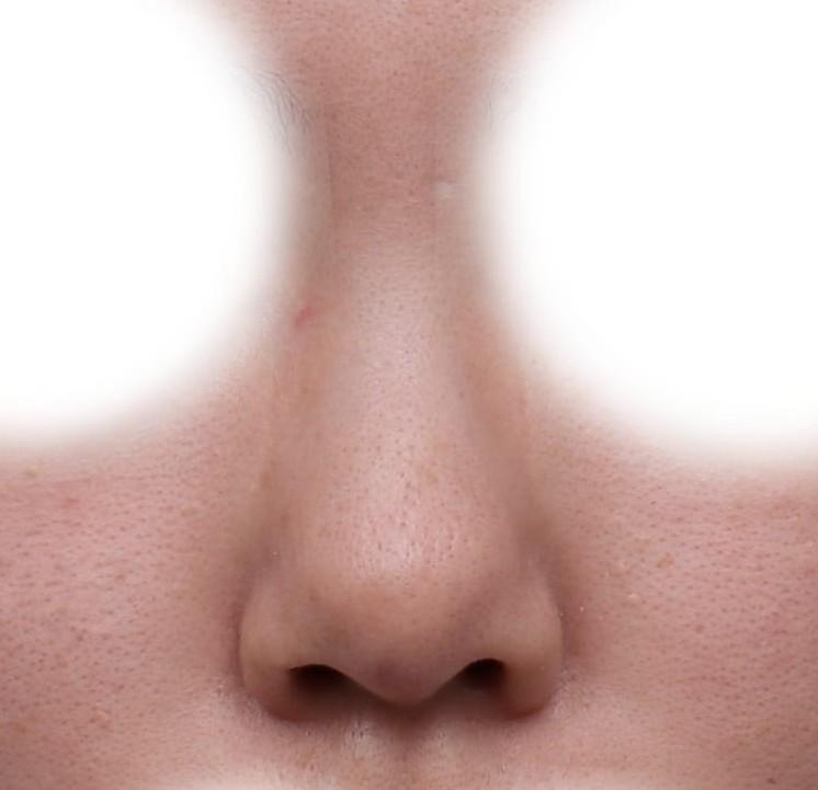 Laser Hair Removal