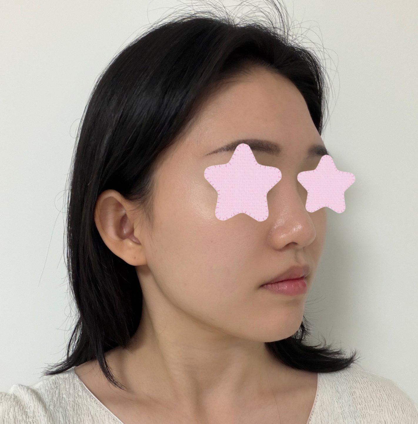Finally tackled freckles and sun damage with Sciton BBL Hero 4