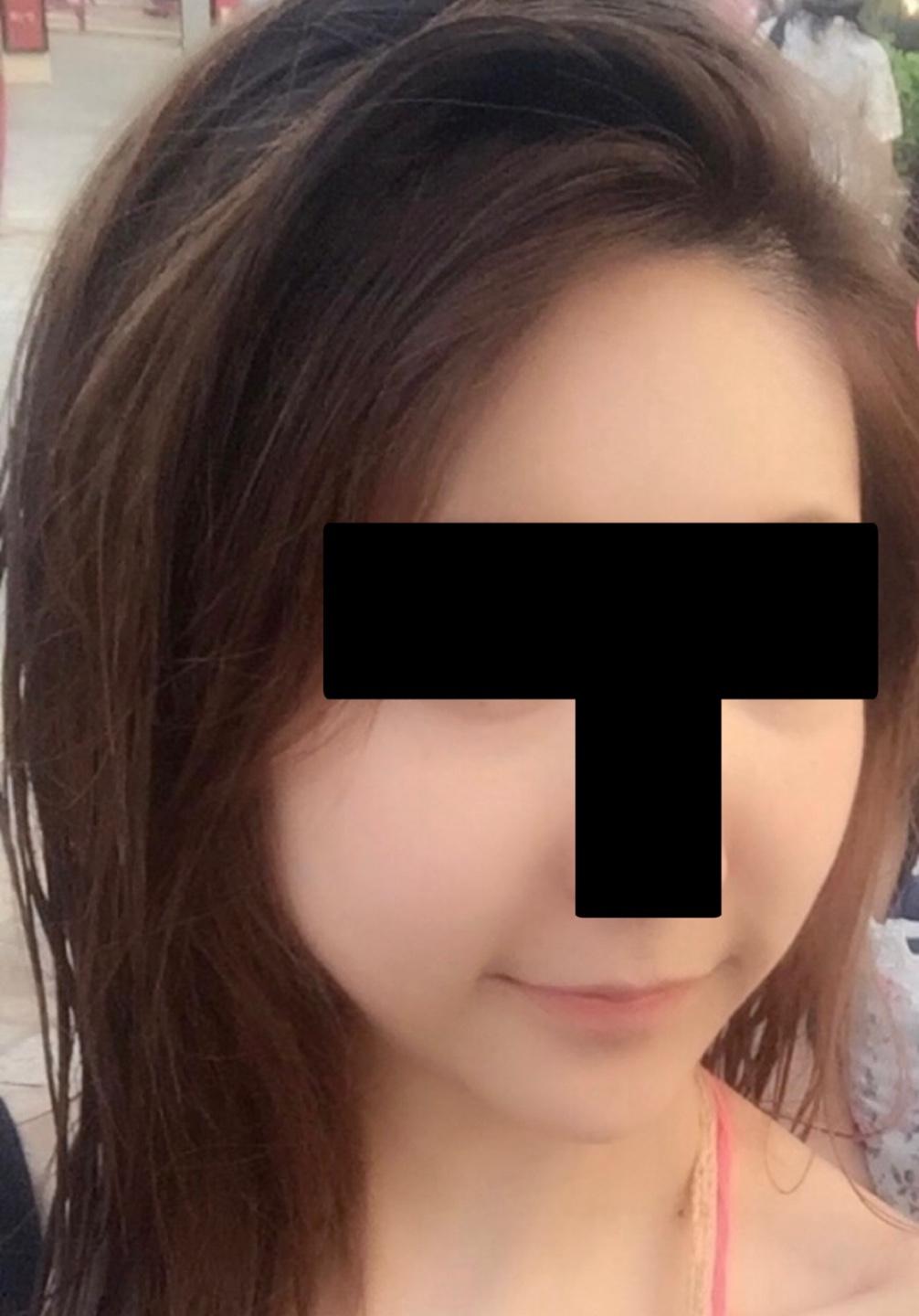 Xerf 点阵射频恢复记录｜眼下松弛和鱼尾纹终于有救了