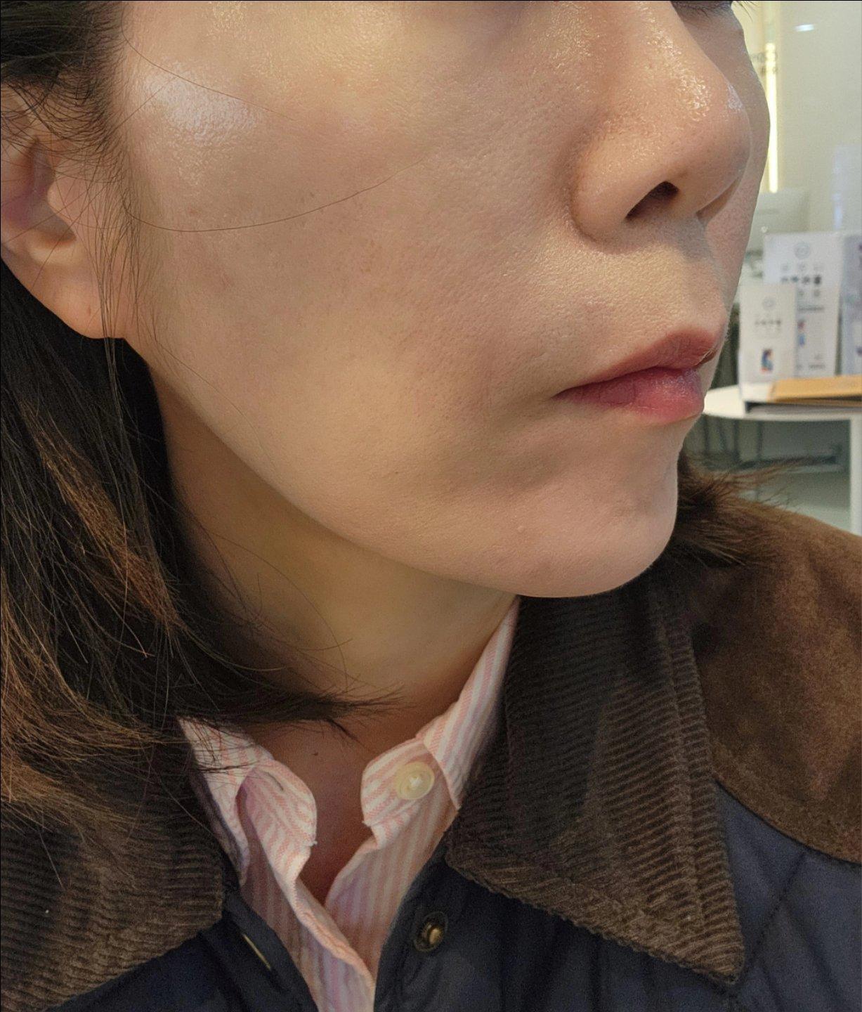 Finally tackled loss of glow and firmness with 5D Collagen Lift