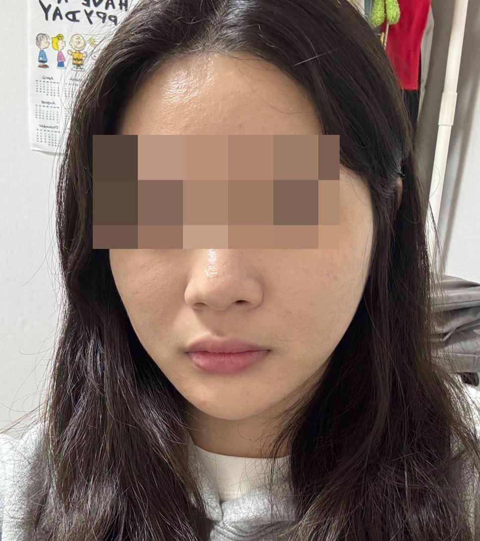 在 FlowMD 做了Ultherapy 超声提升，真实分享✨