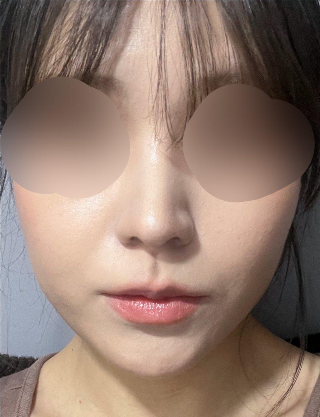 鼻综合整形恢复记录｜鼻梁低、鼻头圆钝终于有救了 4