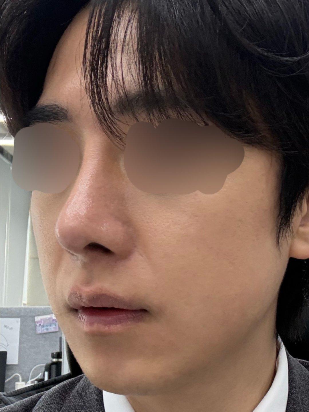 My profile is straight and the tip is refined but natural — so glad I did Rhinoplasty 5