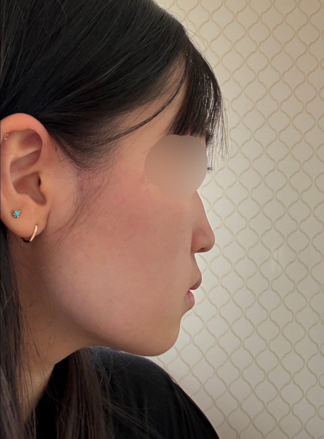 My profile is straight and the tip is refined but natural — so glad I did Rhinoplasty