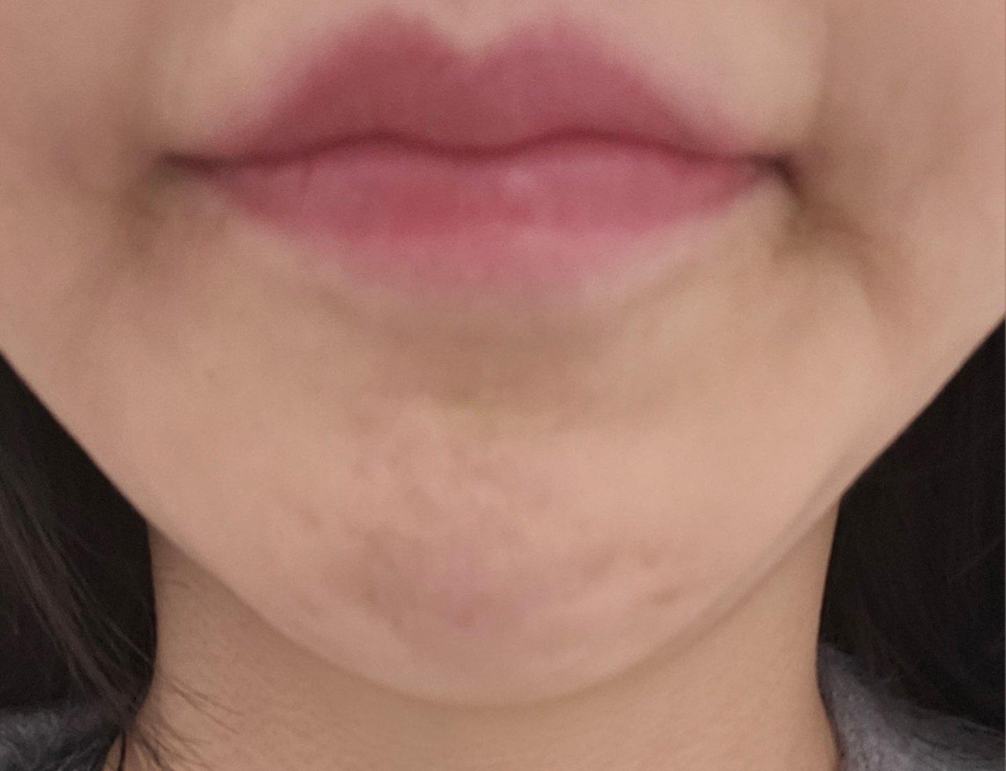 Botox 肉毒素恢复记录｜抬头纹和眉间纹终于有救了 2