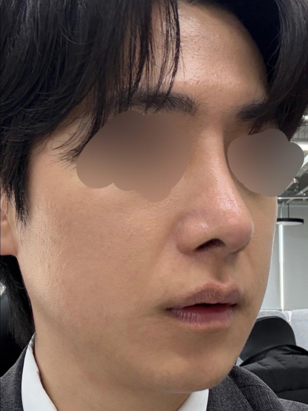 My profile is straight and the tip is refined but natural — so glad I did Rhinoplasty 4