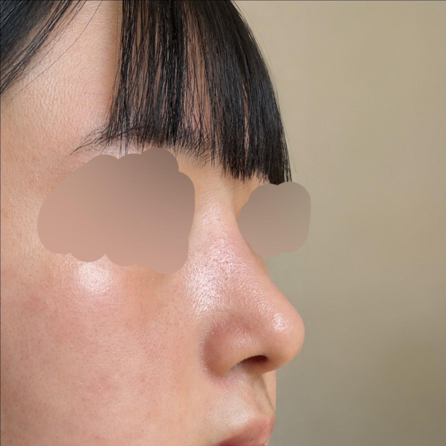 My profile is straight and the tip is refined but natural — so glad I did Rhinoplasty 5