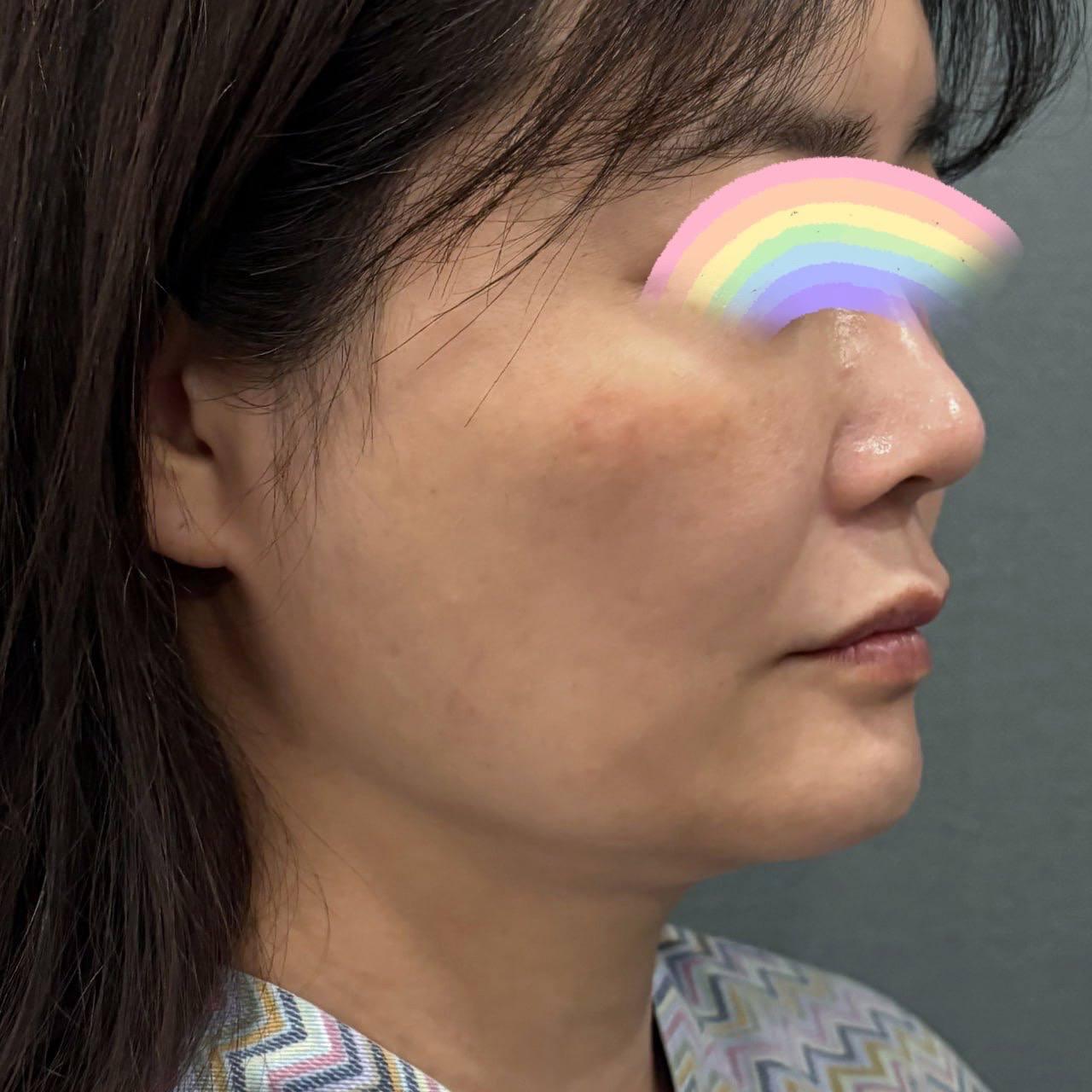 My jawline tightened with barely any downtime — so glad I did AccuTite/FaceTite 2